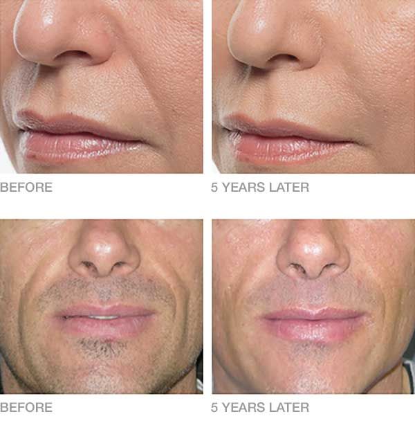 「长效」年轻化注射产品BellaFill-2 (1).jpg